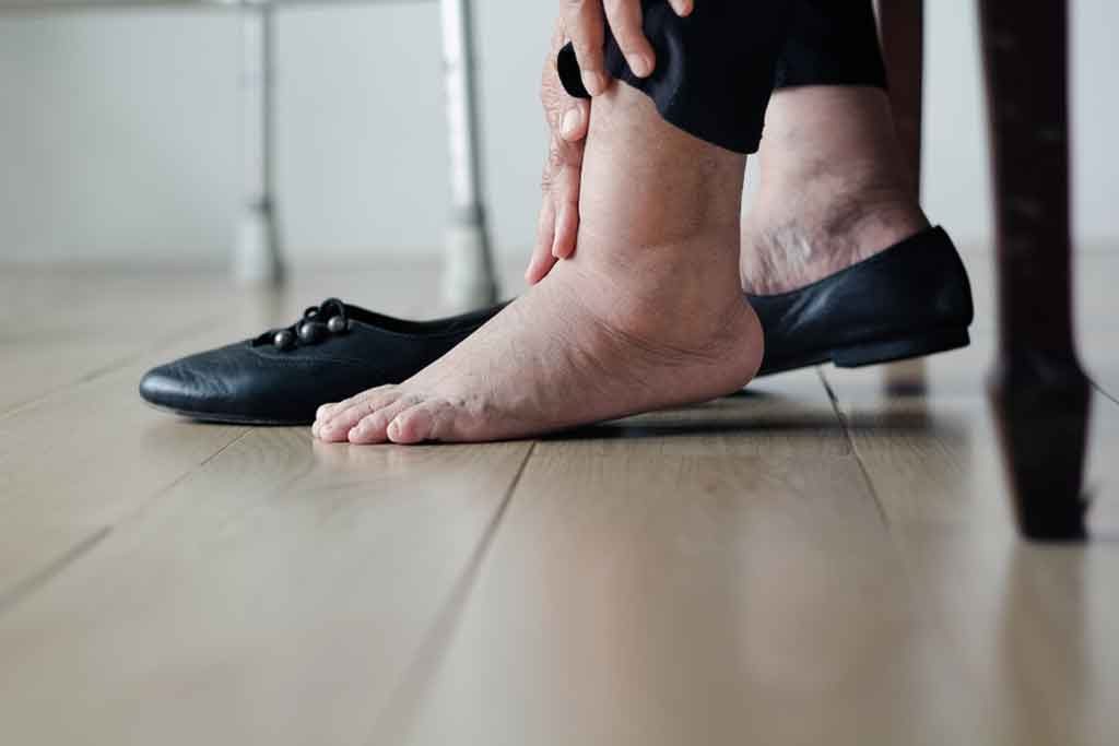 swollen feet symptoms of neuropathy, swollen feet (edema) symptoms of motor nerve damage